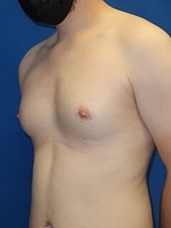 Gynecomastia Treatment Before & After