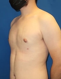Gynecomastia Treatment Before & After