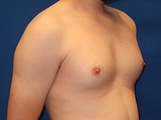 Gynecomastia Treatment Before & After