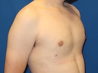 Gynecomastia Treatment Before & After