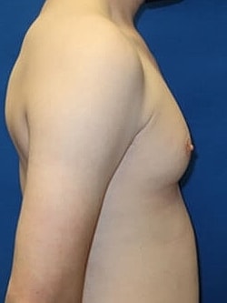 Gynecomastia Treatment Before & After