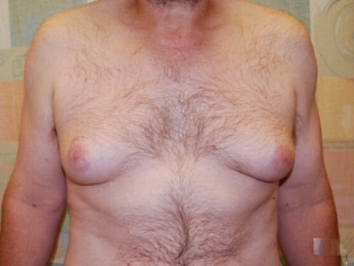 Gynecomastia Treatment Before & After