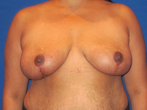 Breast Reduction Before & After