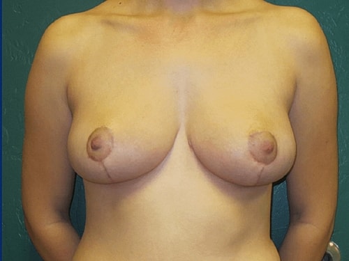 Breast Reduction Before & After