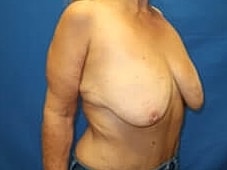 Breast Lift Before & After