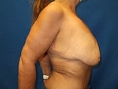 Breast Lift Before & After