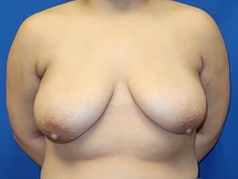 Breast Lift Before & After