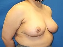 Breast Lift Before & After