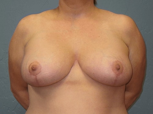 Breast Lift Before & After