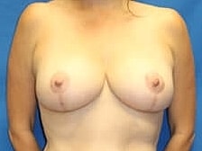Breast Lift Before & After