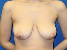 Breast Lift Before & After