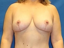 Breast Lift Before & After