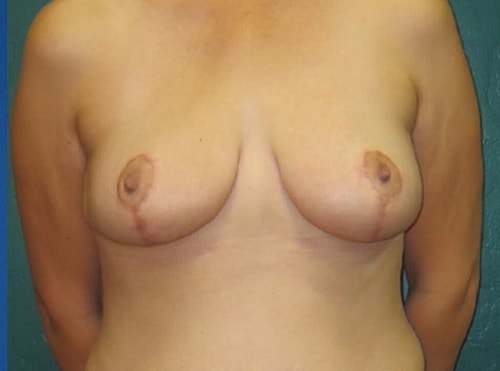 Breast Lift Before & After