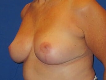 Breast Lift Before & After