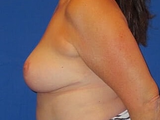 Breast Lift Before & After