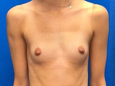 Breast Augmentation Before & After
