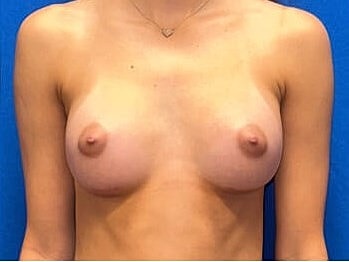 Breast Augmentation Before & After