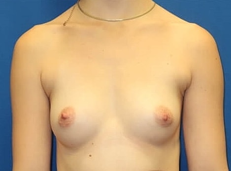 Breast Augmentation Before & After