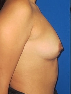 Breast Augmentation Before & After