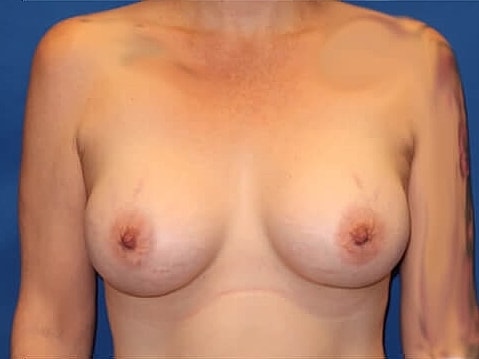 Breast Augmentation Before & After
