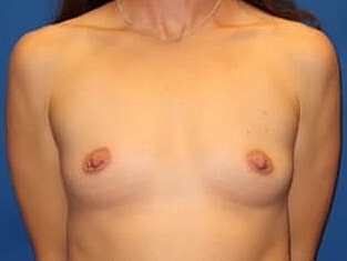 Breast Augmentation Before & After