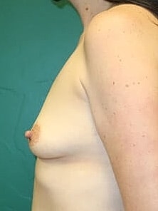 Breast Augmentation Before & After