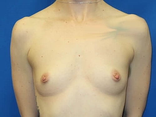 Breast Augmentation Before & After