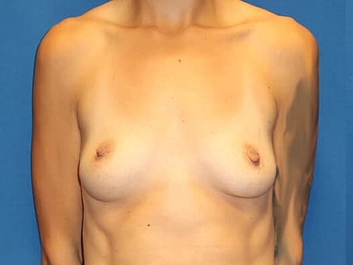 Breast Augmentation Before & After