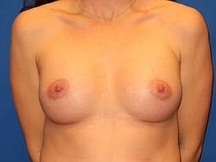 Breast Augmentation Before & After