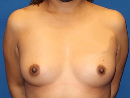 Breast Augmentation Before & After