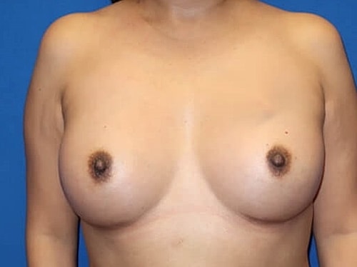 Breast Augmentation Before & After