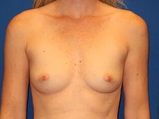 Breast Augmentation Before & After