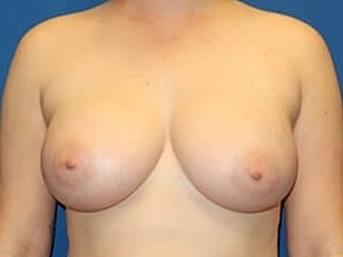 Breast Augmentation Before & After
