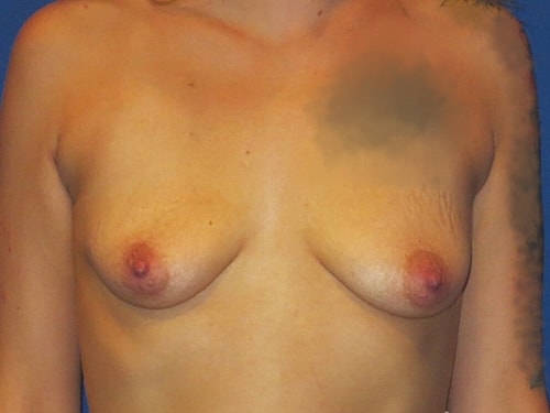 Breast Augmentation Before & After