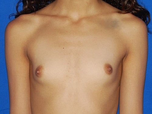 Breast Augmentation Before & After