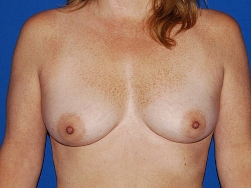 Breast Augmentation Before & After