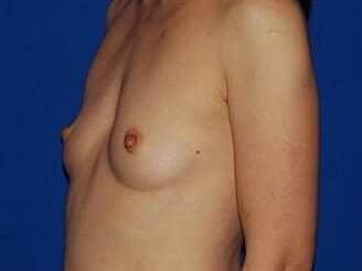 Breast Augmentation Before & After