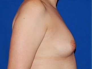 Breast Augmentation Before & After