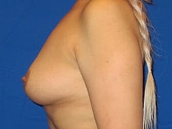 Breast Augmentation Before & After