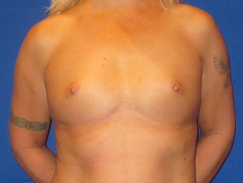 Breast Augmentation Before & After