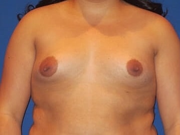 Breast Augmentation Before & After
