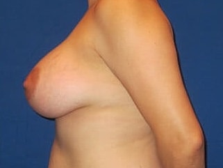 Breast Augmentation Before & After