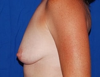 Breast Augmentation Before & After