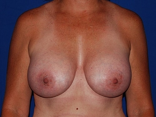 Breast Augmentation Before & After
