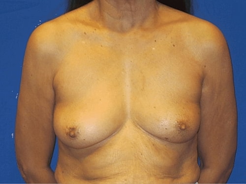 Breast Augmentation Before & After