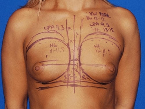 Breast Augmentation Before & After