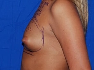 Breast Augmentation Before & After