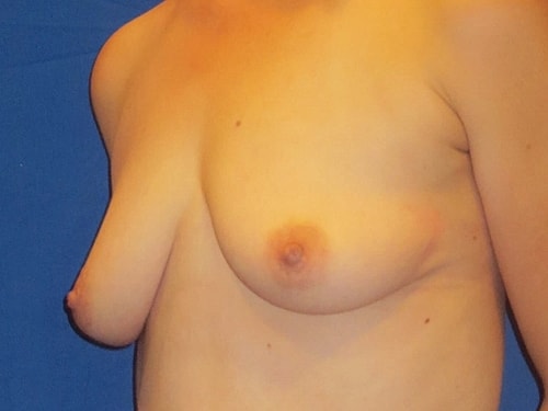 Breast Augmentation Before & After