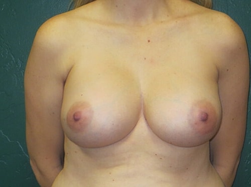 Breast Augmentation Before & After