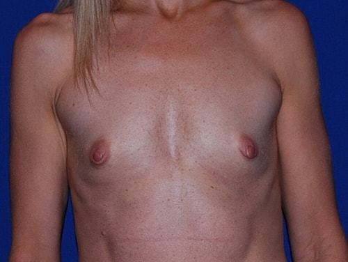 Breast Augmentation Before & After